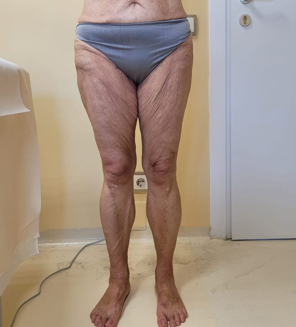 Imagine clinică pentru protocolul de drenaj limfatic Lymph Flow