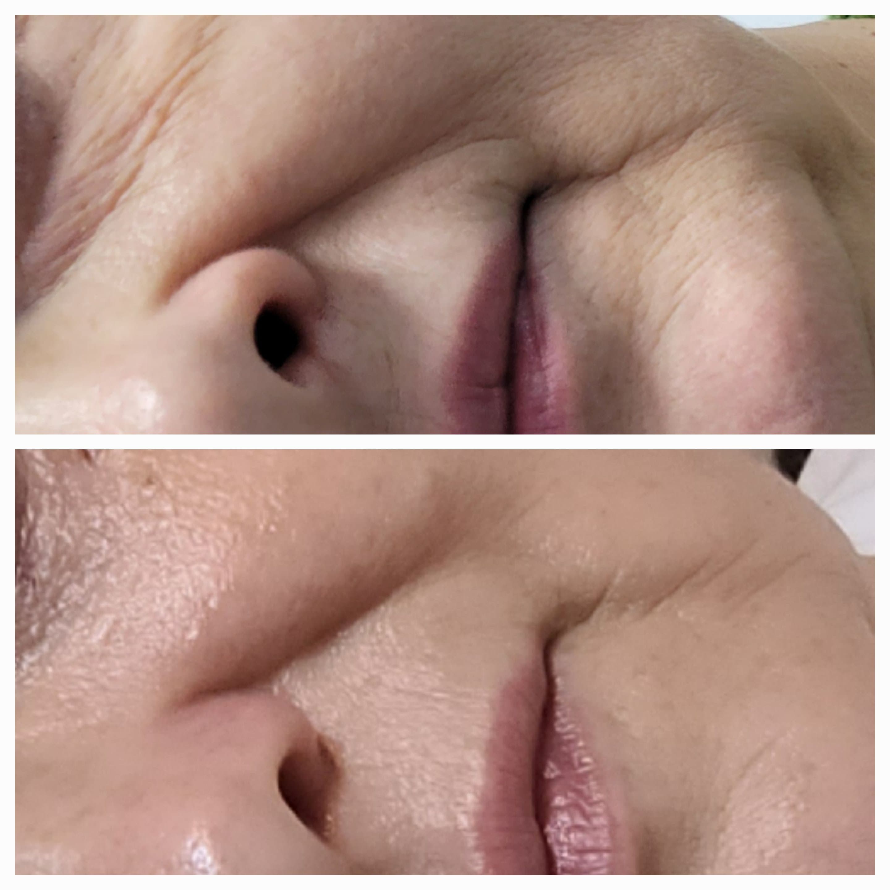 Facial ReLift™